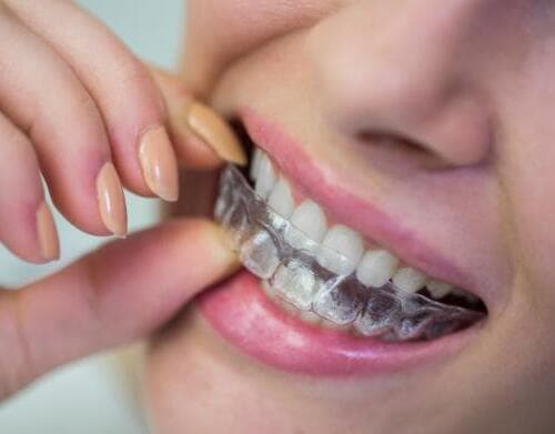 Aligners