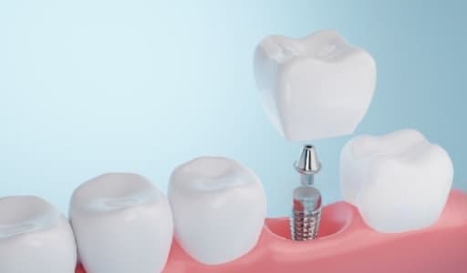 Dental Implant Prosthesis — before treatment