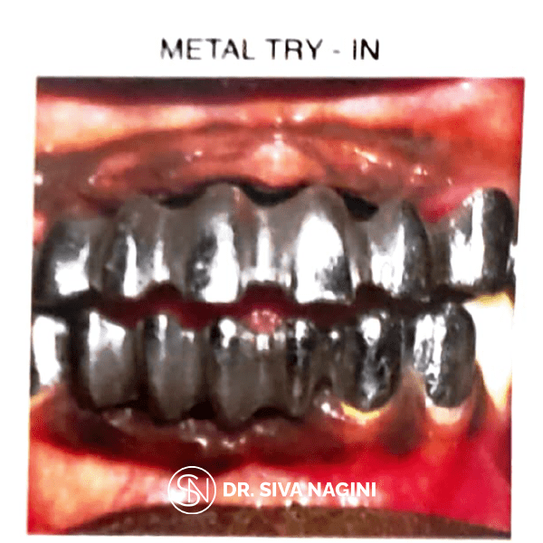 Partial Denture Case — case photo 11