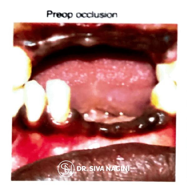 Partial Denture Case — case photo 12