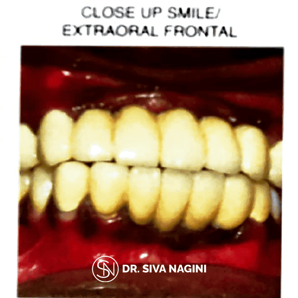 Partial Denture Case — case photo 13