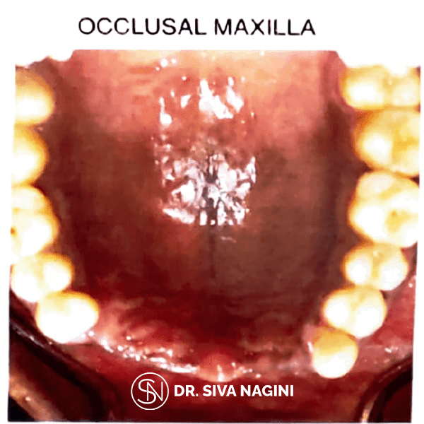 Partial Denture Case — case photo 1