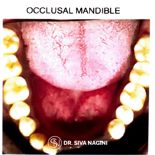 Partial Denture Case — case photo 2