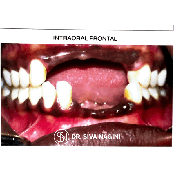 Partial Denture Case — case photo 3