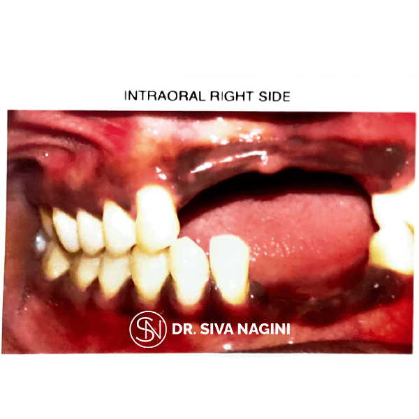 Partial Denture Case — case photo 4