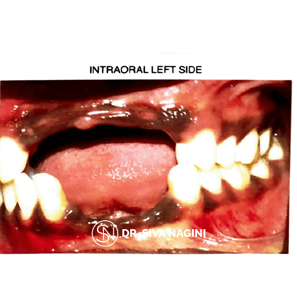 Partial Denture Case — case photo 5