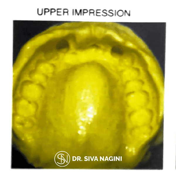 Partial Denture Case — case photo 6