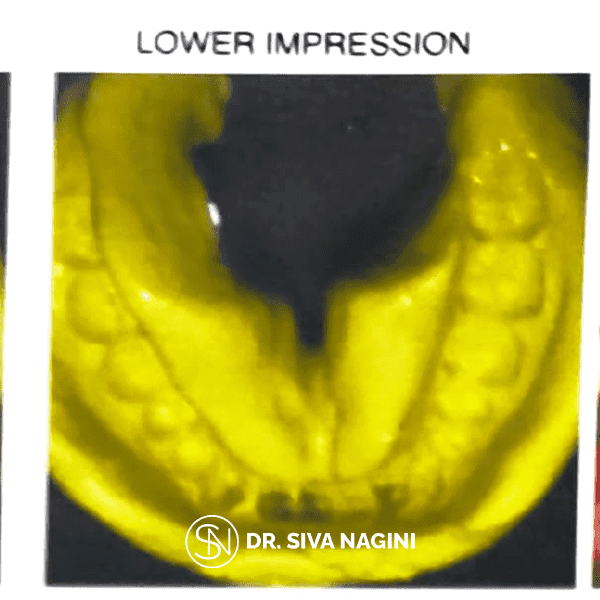 Partial Denture Case — case photo 7