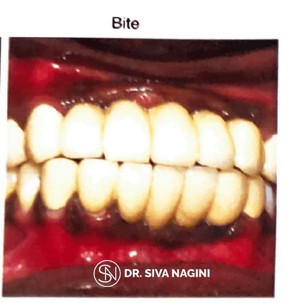 Partial Denture Case — case photo 8