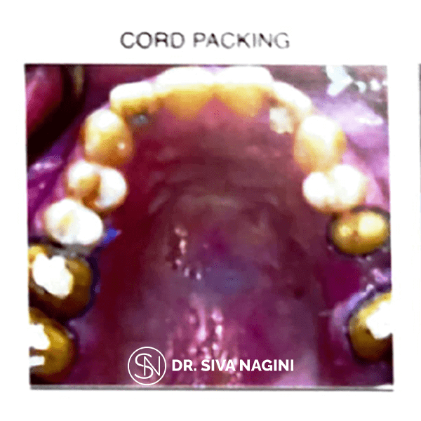 Dental implant prosthesis — case photo 8