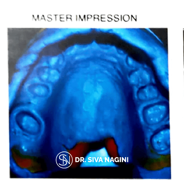 Dental implant prosthesis — case photo 9
