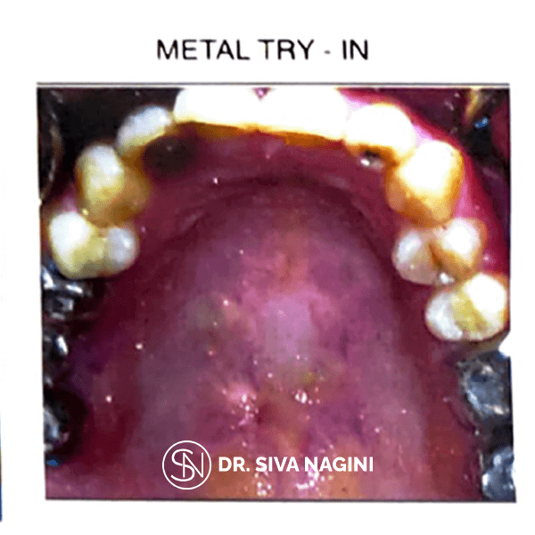 Dental implant prosthesis — case photo 10