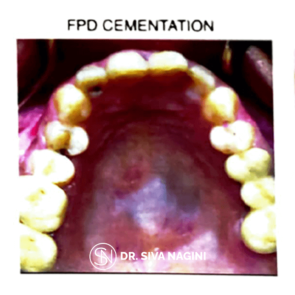 Dental implant prosthesis — case photo 11