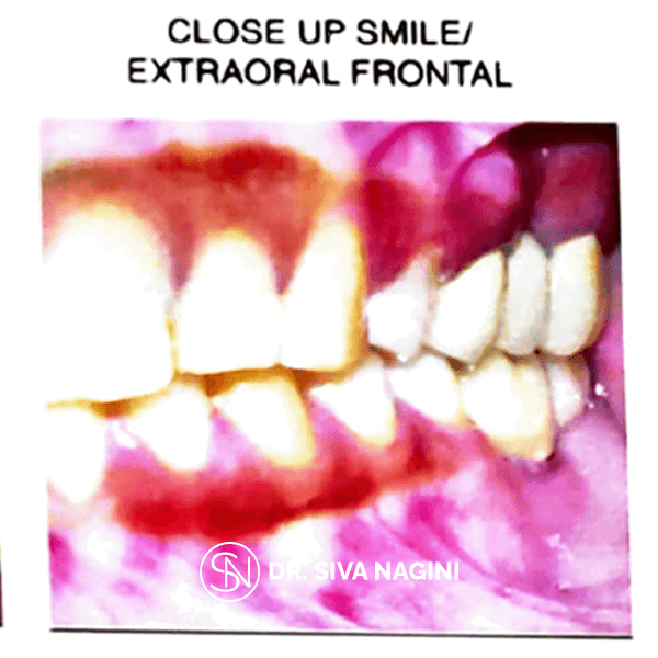 Dental implant prosthesis — case photo 12