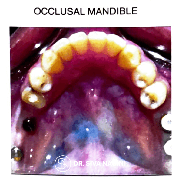 Dental implant prosthesis — case photo 1