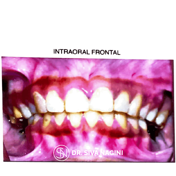 Dental implant prosthesis — case photo 2