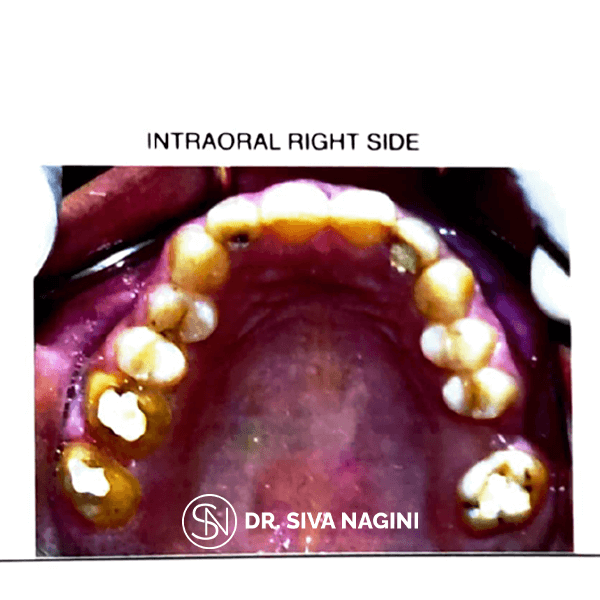 Dental implant prosthesis — case photo 3