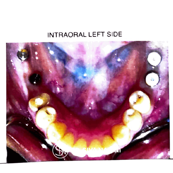 Dental implant prosthesis — case photo 4