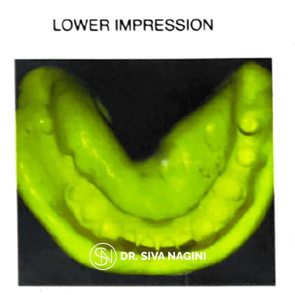 Dental implant prosthesis — case photo 6