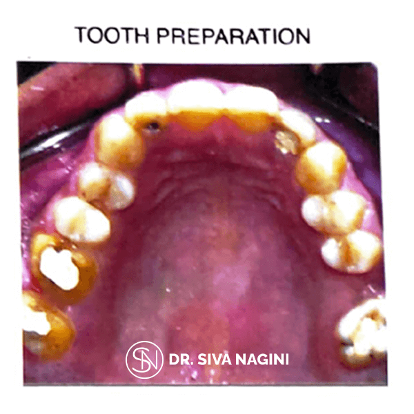 Dental implant prosthesis — case photo 7
