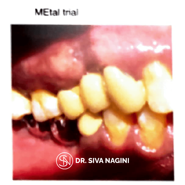 Fixed partial denture — case photo 9
