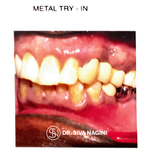 Fixed partial denture — case photo 10
