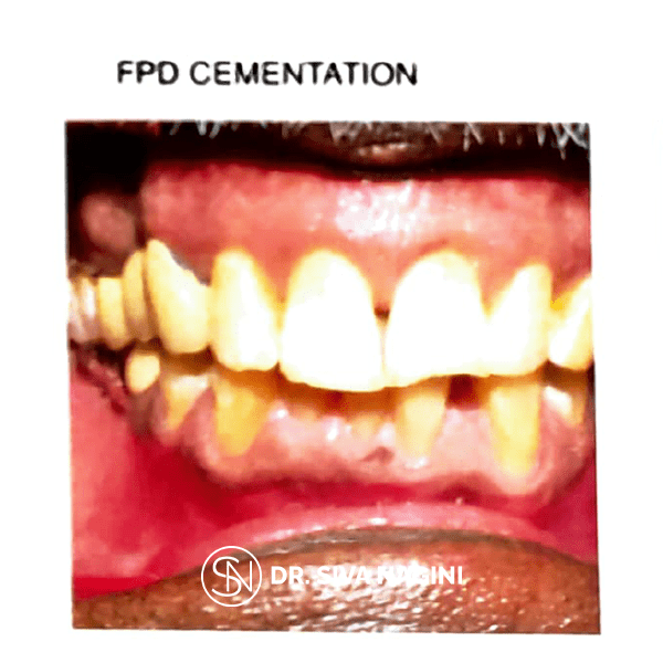 Fixed partial denture — case photo 11