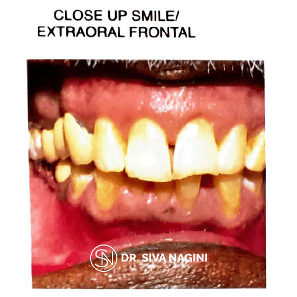 Fixed partial denture — case photo 12