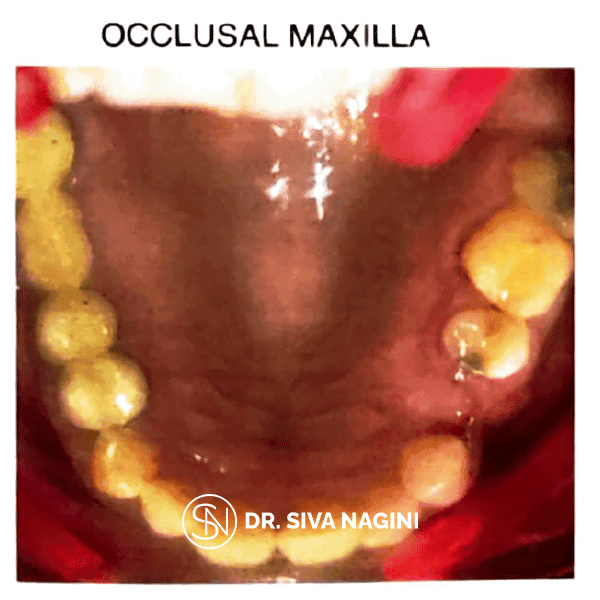 Fixed partial denture — case photo 1