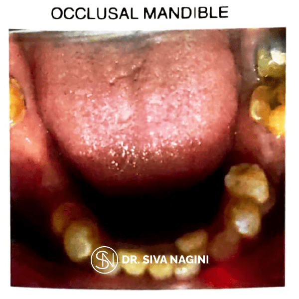 Fixed partial denture — case photo 2