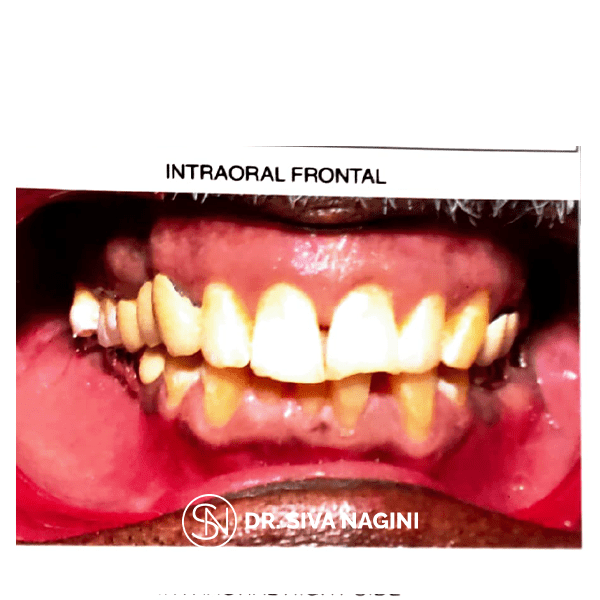 Fixed partial denture — case photo 3