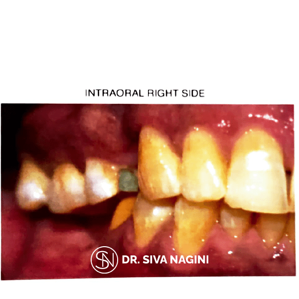 Fixed partial denture — case photo 4