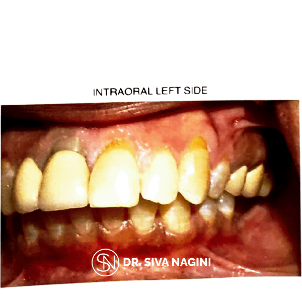 Fixed partial denture — case photo 5
