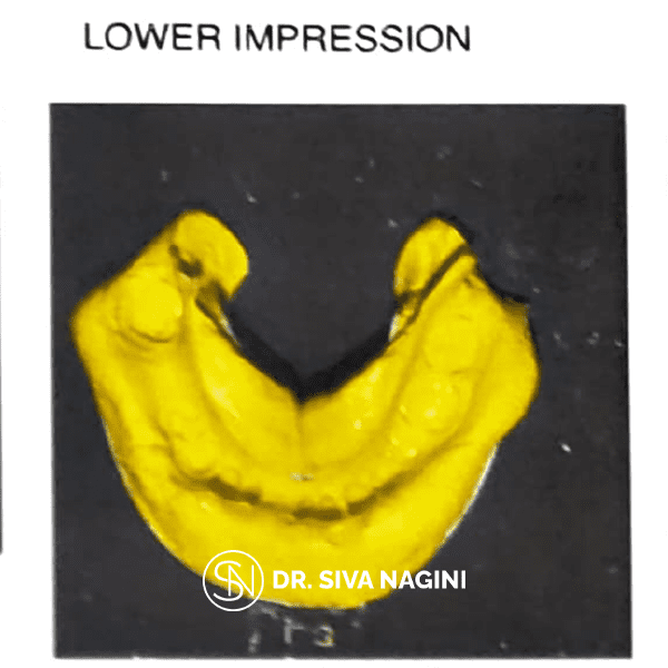 Fixed partial denture — case photo 7