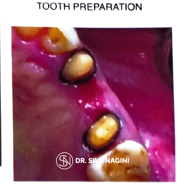 Fixed partial denture — case photo 8