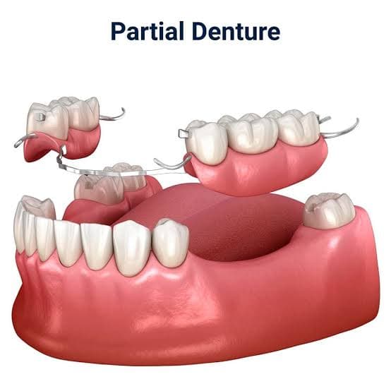 Partial Denture — before treatment