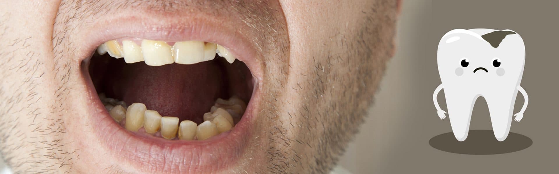 Treating Advanced Tooth Decay