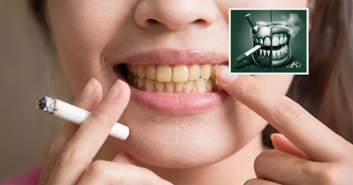 The Silent Trap of Smoking: Hidden Effects on Gums, Teeth & Dental Implants
