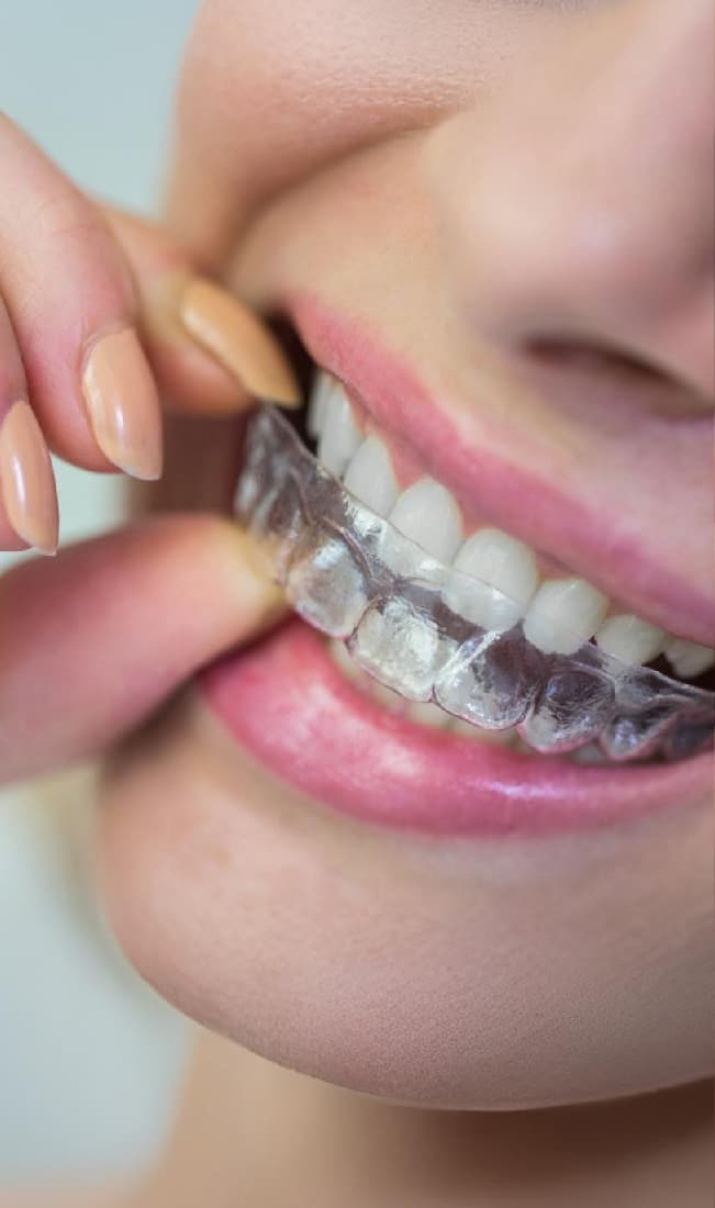 Aligners at Aura