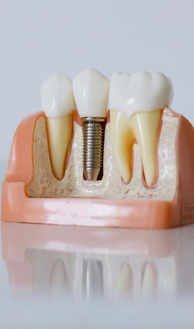 Dental Implants at Aura