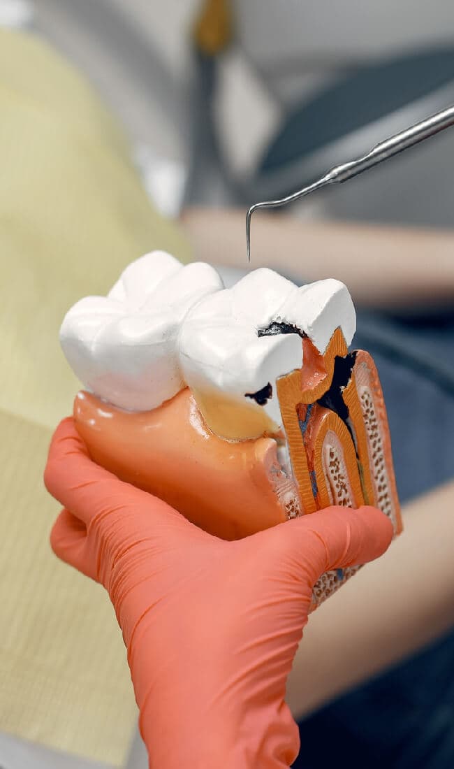 Root Canal Treatment at Aura