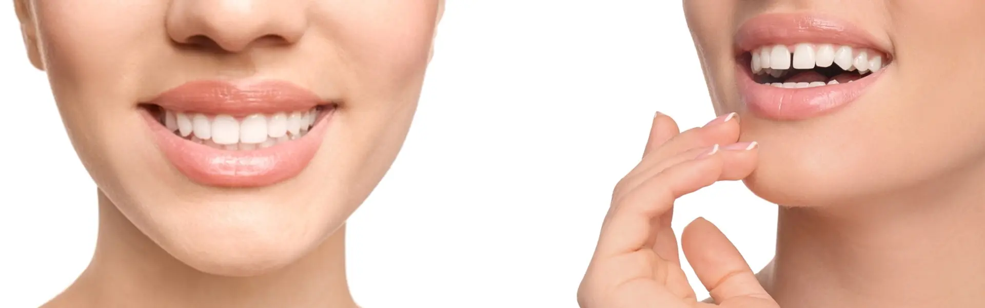 Closing the Gap with Metal Braces